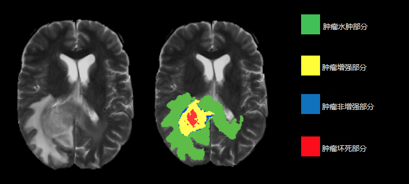 多模脑部图像的肿瘤特征分析